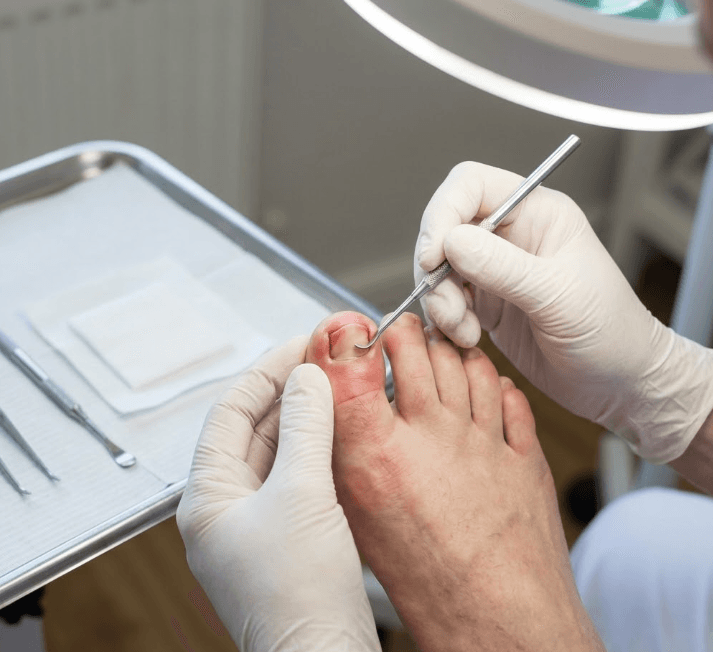 Tratamiento de uña encarnada en DM Podología Colmenar Viejo