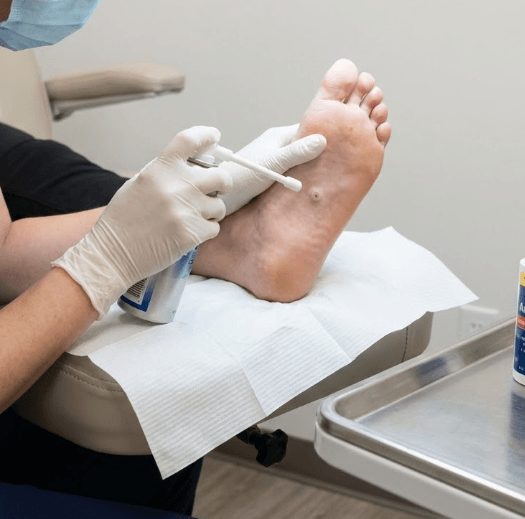 Tratamiento de papilomas y hongos en DM Podología Colmenar Viejo